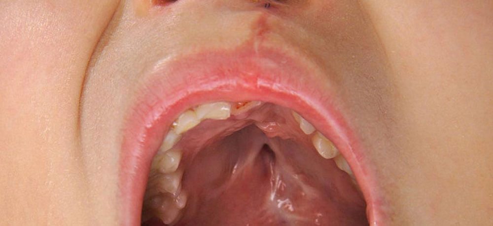 cleft-lip-palate-surgery