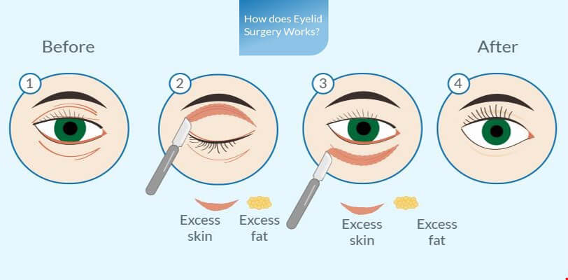 eyelid-surgery-procedure-before-after-image
