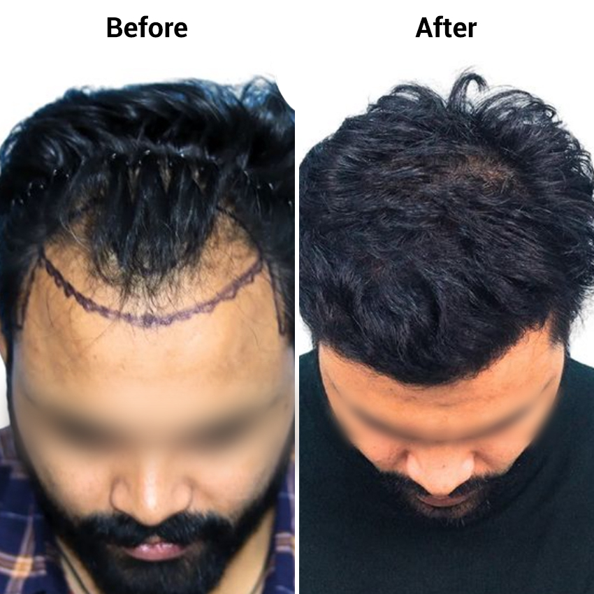 hair-transplant-before-after-image