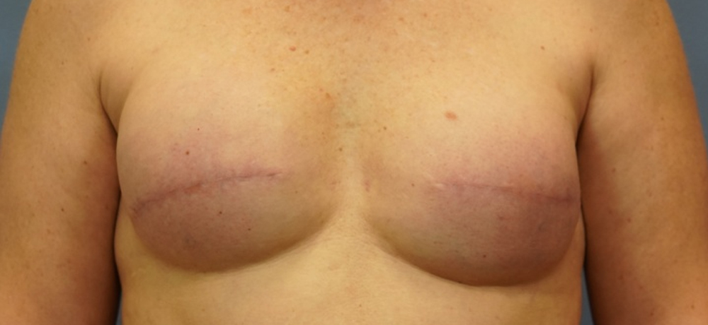 nipple-reconstruction