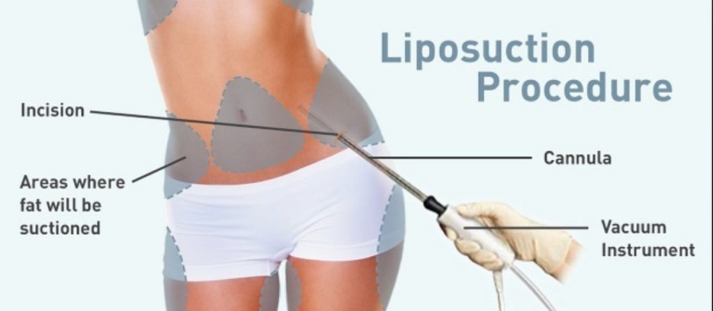 Procedure of Liposuction Surgery