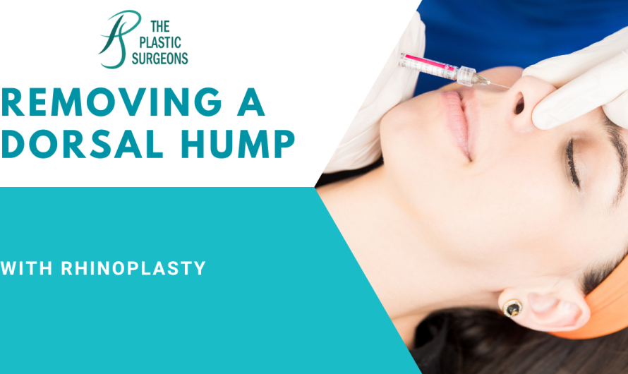 Removing a Dorsal Hump with Rhinoplasty