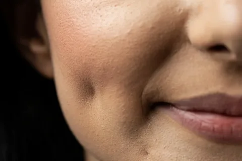 Are Dimples Genetic? Exploring the Science