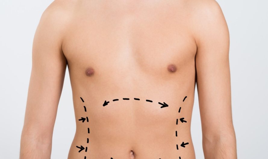 Liposuction for Men: Common Concerns and Benefits