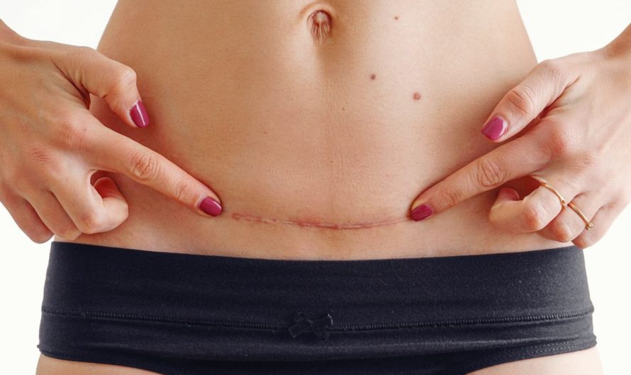 Liposuction Scars: Minimizing and Managing