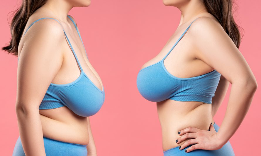 Breast Augmentation and Pregnancy: Considerations