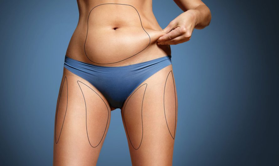 Localized Fat Deposits: Can Liposuction Help?