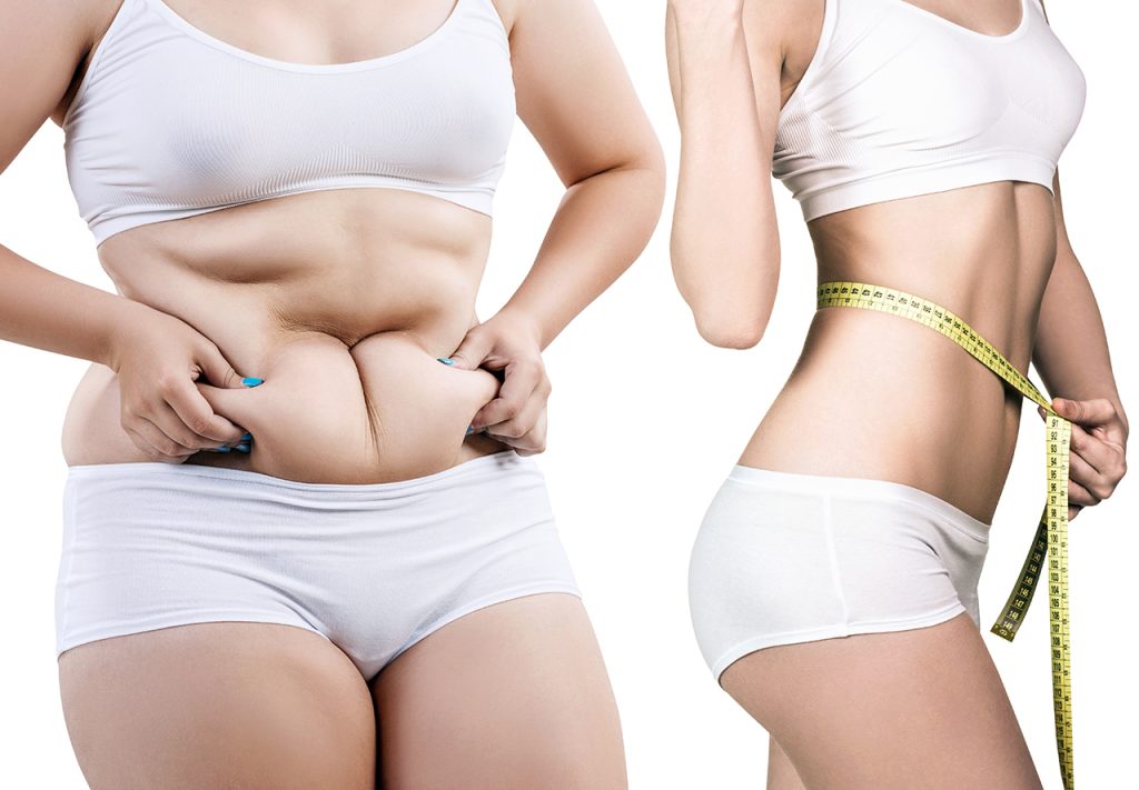 Effectiveness of Liposuction for Weight Loss