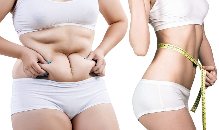 Liposuction for Weight Loss