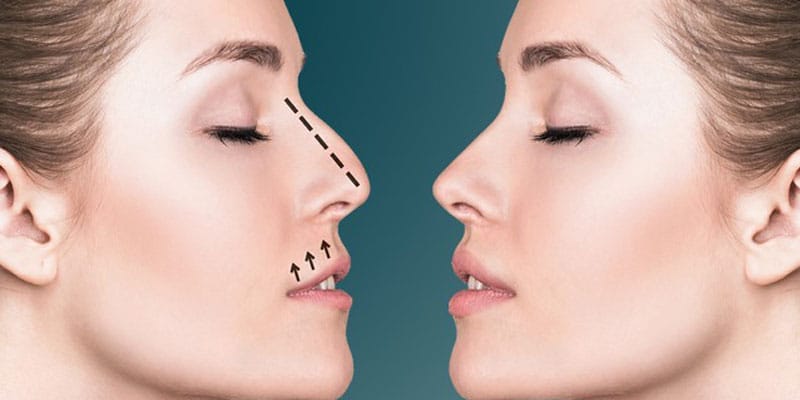 Why is Rhinoplasty Procedure Important?