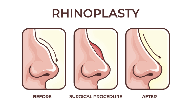 How Much Does Rhinoplasty Cost?