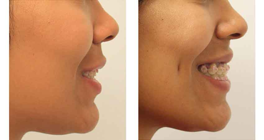Dimpleplasty Cost in Mumbai: What to Expect