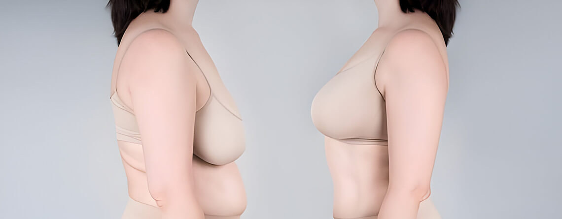 Durability and Longevity: How Long Will Breast Implants Last?