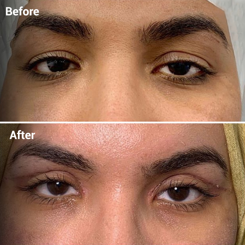 Benefits of Eyebrow Lift Surgery in Mumbai