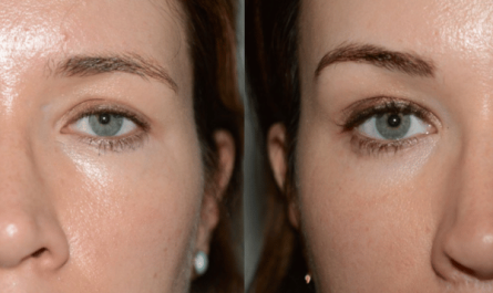 Eyebrow Lift Surgery in Mumbai: Achieve a Youthful Look