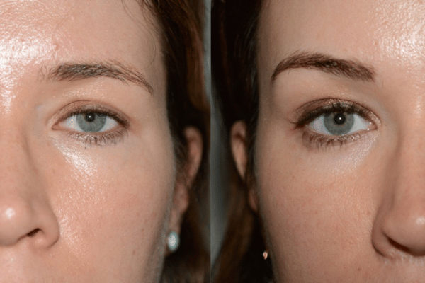 Eyebrow Lift Surgery in Mumbai: Achieve a Youthful Look