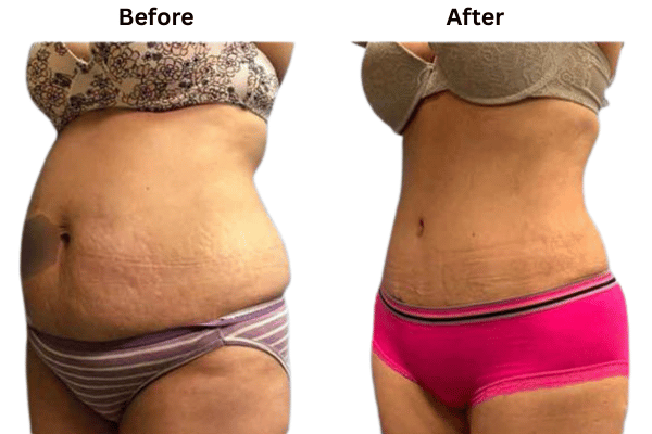 Liposuction Procedure in Mumbai at The Plastic Surgeons