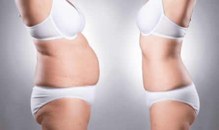 Liposuction Procedure in Mumbai : Sculpt Your Body with Confidence