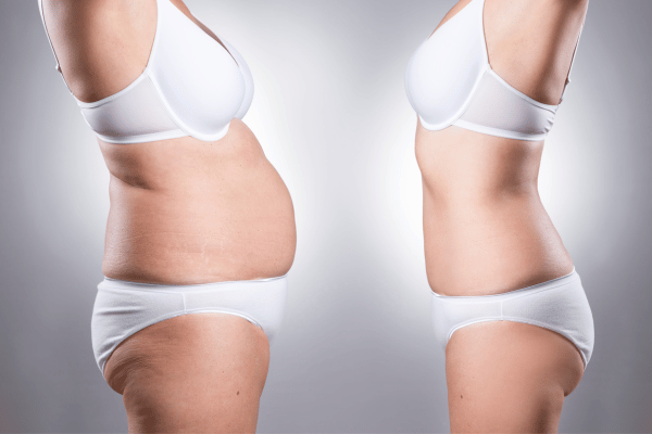 Liposuction Procedure in Mumbai : Sculpt Your Body with Confidence