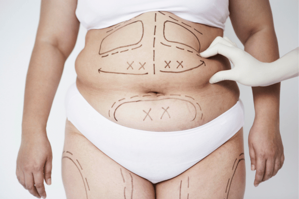 Liposuction procedure in Mumbai with The plastic Surgeons