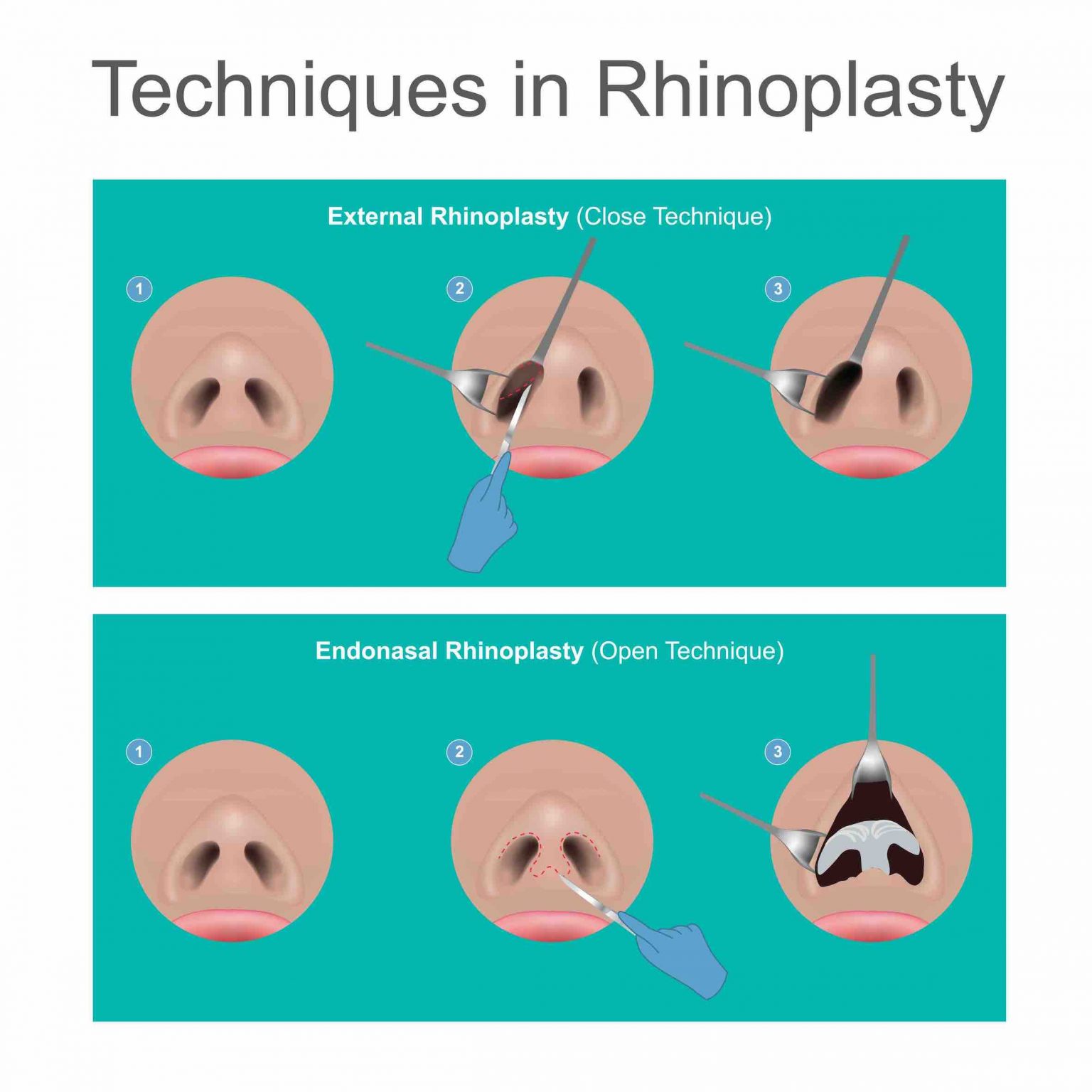 What Happens During the Rhinoplasty Procedure?