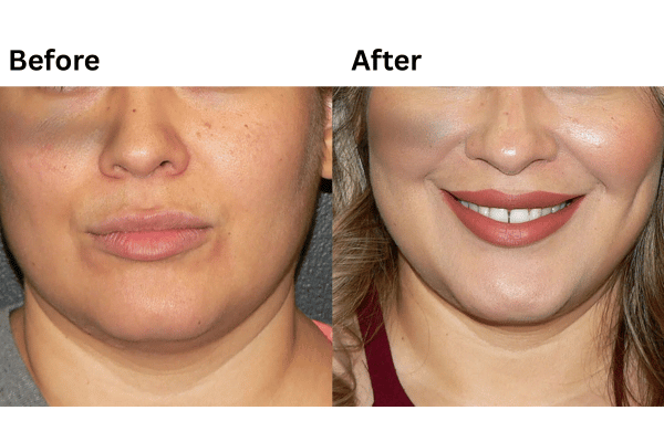 Understanding Dimpleplasty in Mumbai with The Plastic Surgeons