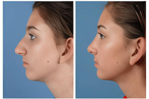 What is Rhinoplasty Procedure