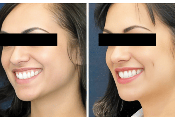 understanding why Choose Mumbai for Dimpleplasty at The Plastic Surgeons