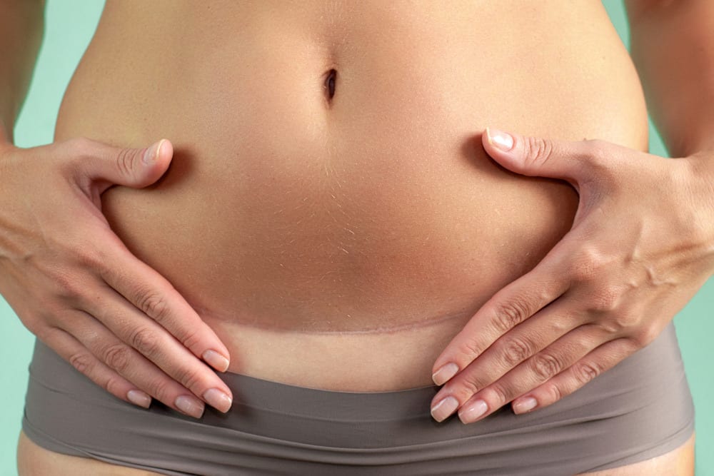 Tummy Tuck After C-Section at Mumbai