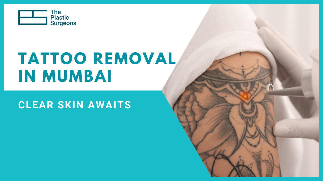 Affordable Tattoo Removal in Mumbai: Clear Skin Awaits