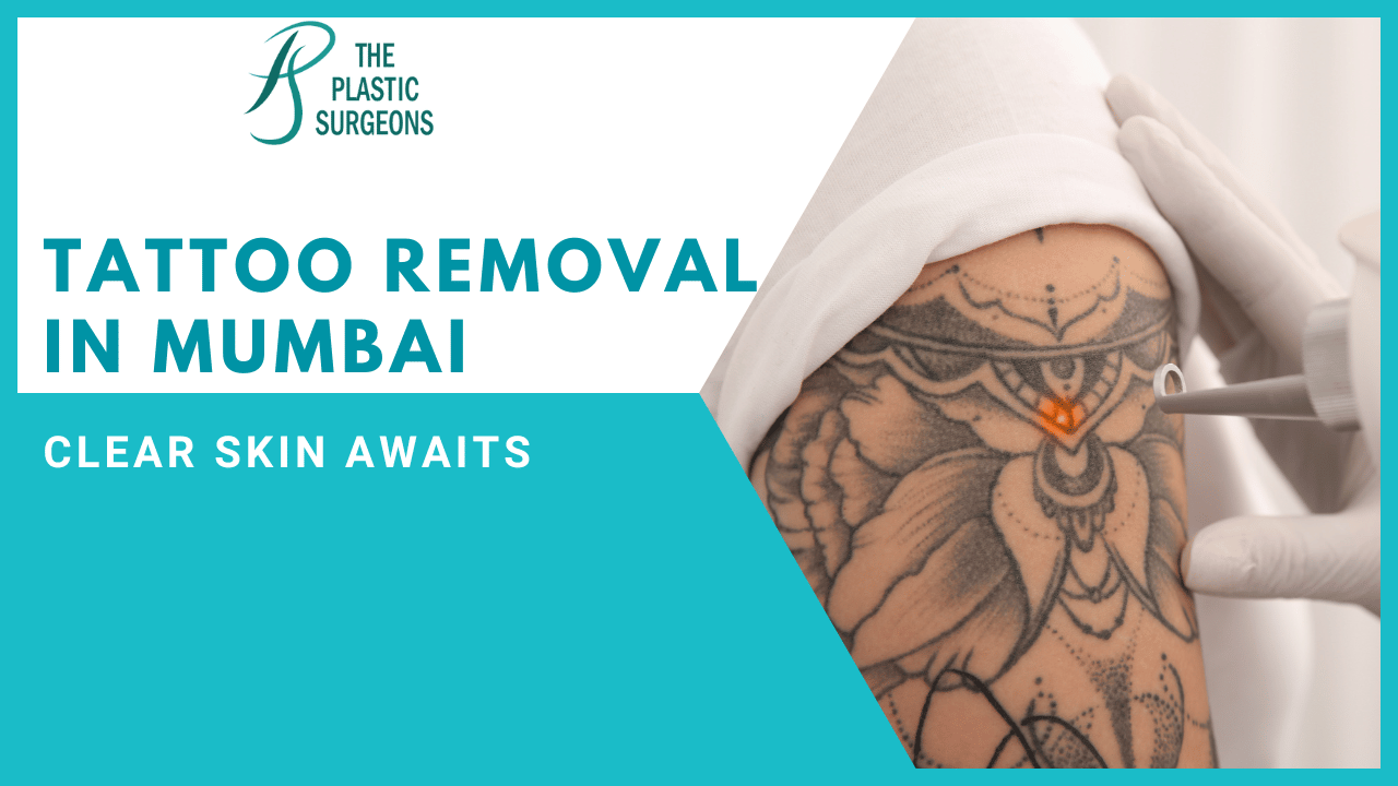 Affordable Tattoo Removal in Mumbai: Clear Skin Awaits