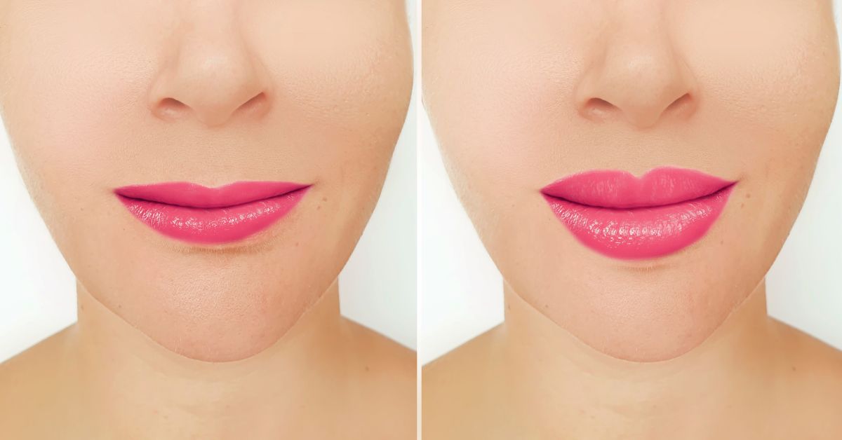 What to Expect Before, During, and After Lip Augmentation Surgery