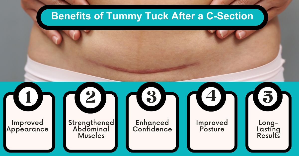 Benefits of Tummy Tuck After a C-Section