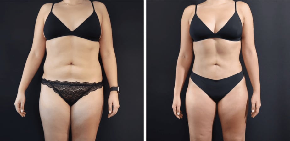 Understanding Body Lift Surgery