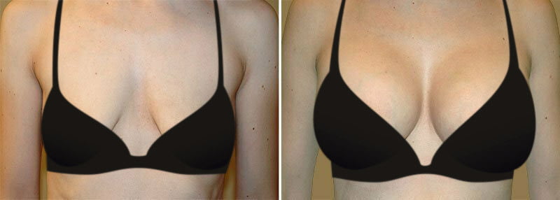 Breast Augmentation: Enhancing Volume