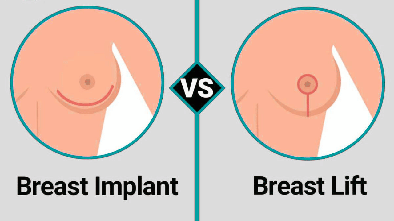 Breast Augmentation vs. Breast Lift: Which Procedure is Right for You?