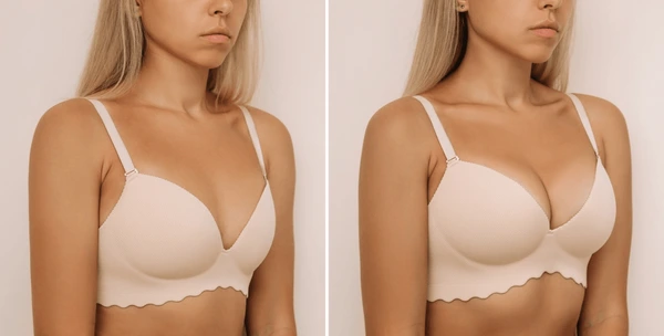 Breast Lift (Mastopexy): Lifting and Firming