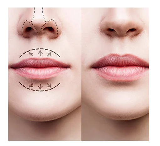 Lip Augmentation Surgery Mumbai with The Plastic Surgeons