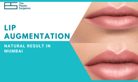 Natural Lip Augmentation Surgery in Mumbai
