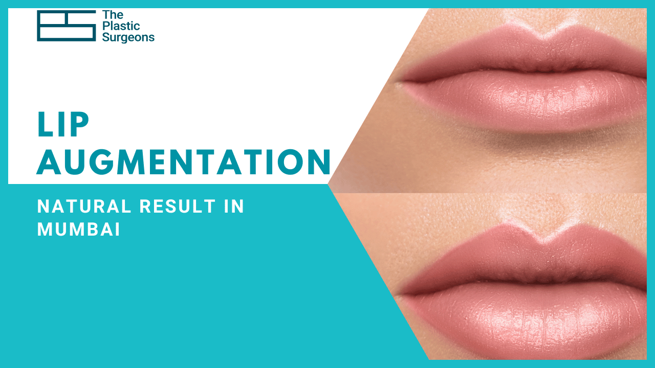 Natural Lip Augmentation Surgery in Mumbai