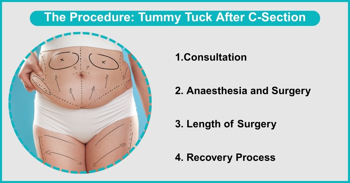The Procedure: Tummy Tuck After C-Section in Mumbai at the Plastic surgeons