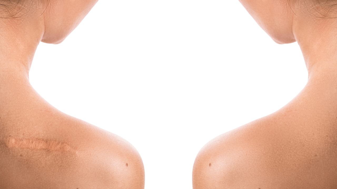 What Is Scar Discoloration After Plastic Surgery?