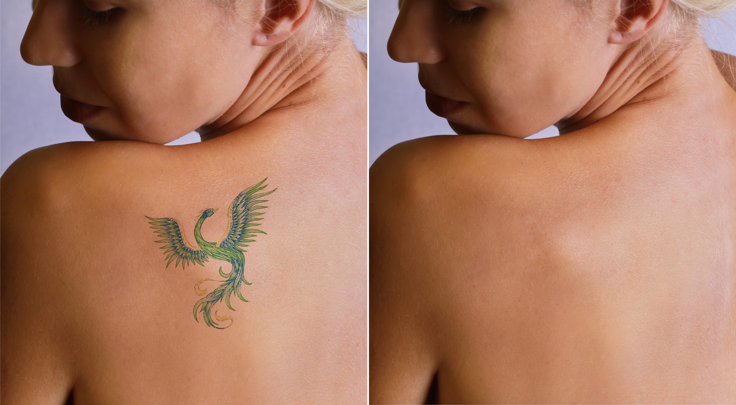 Why Tattoo Removal is Important?
