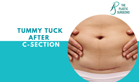 Tummy Tuck After a C-Section In Mumbai