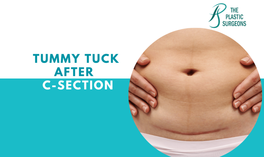 Tummy Tuck After a C-Section In Mumbai
