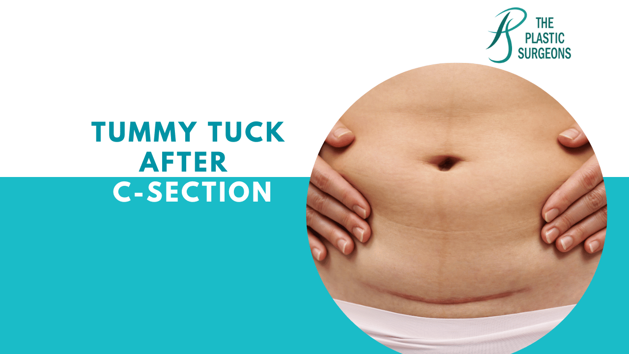 Tummy Tuck After a C-Section In Mumbai