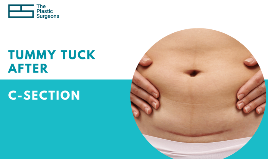 Tummy Tuck After a C-Section In Mumbai