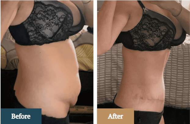 Why Consider a Tummy Tuck After a C-Section?