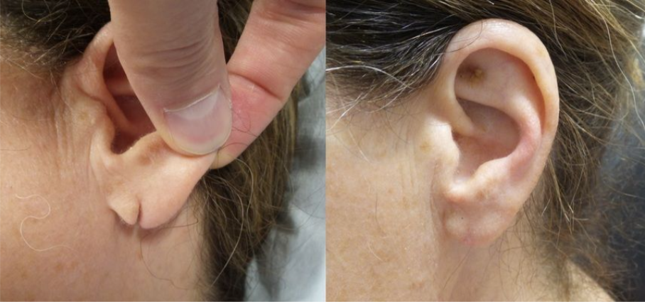 What is Ear Hole Repair in Mumbai