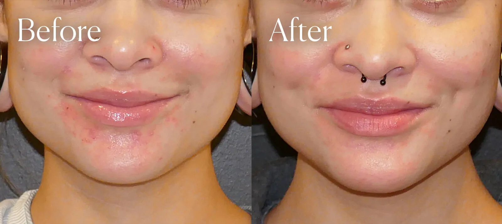 Choosing the Right Surgeon for Dimpleplasty